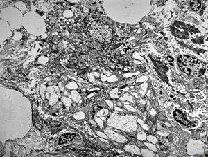 Whipple disease Whipple disease